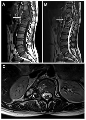 Case Report: Diagnosis of vertebral alveolar echinococcosis upon next-generation sequencing in a suspected tuberculosis